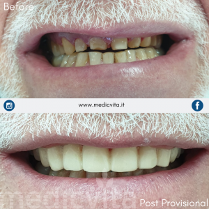 Ponte provvisorio arcata superiore (elementi dentali dal 14 al 24)